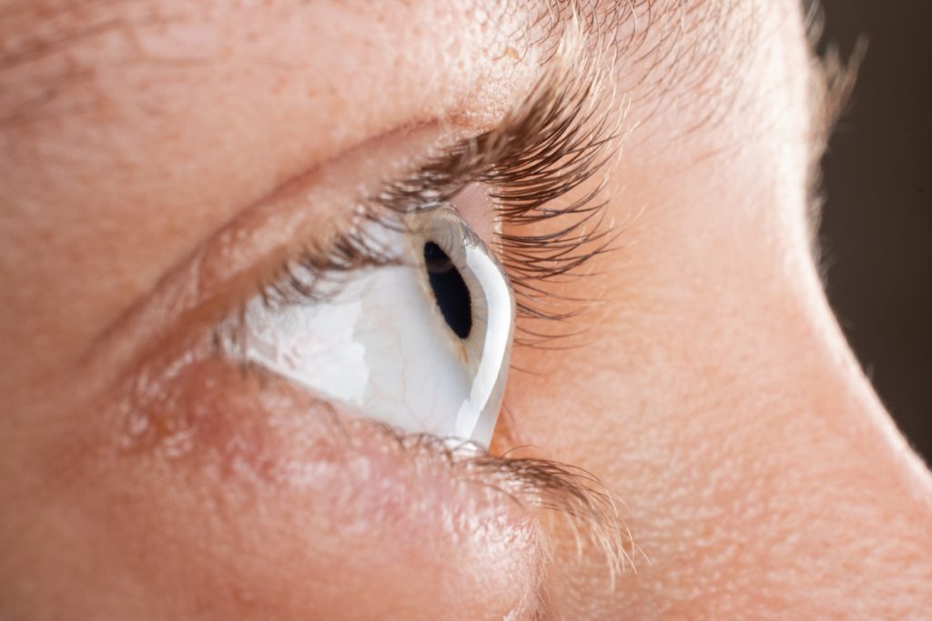Óptica Raga - ojo con queratocono lentes esclerales