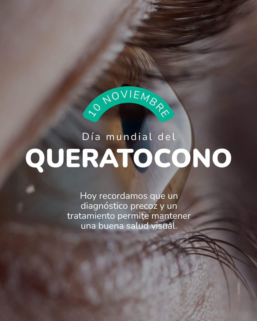 Día Mundial del Queratocono en Óptica Raga